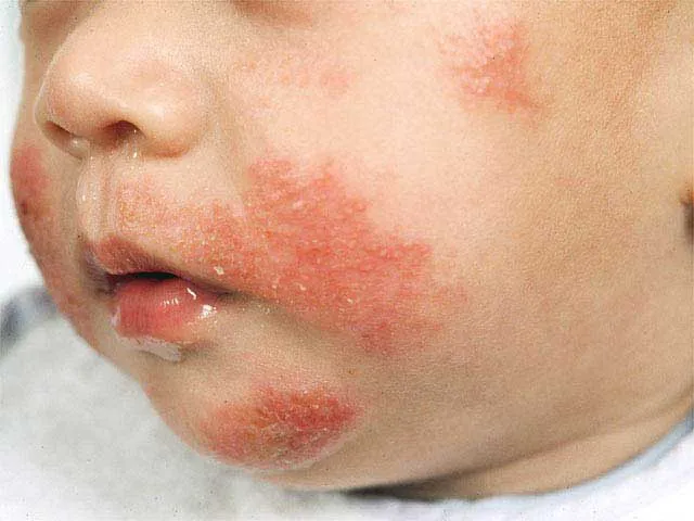 atopic dermatitis baby