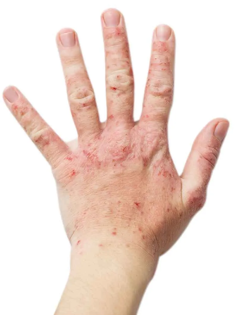 atopic dermatitis hand