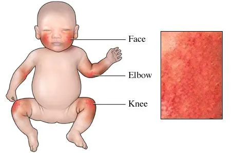 atopic dermatitis baby