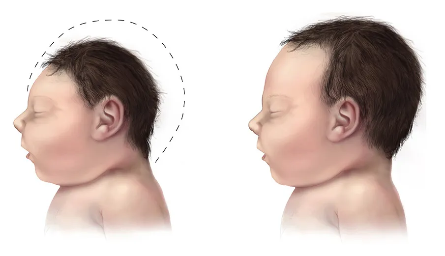 Microcephaly baby