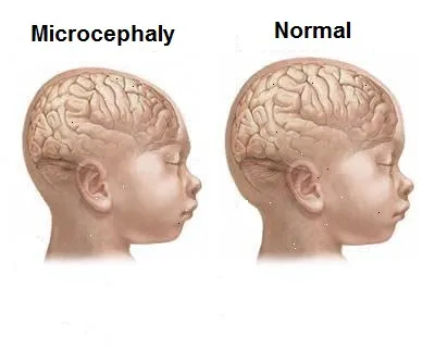 microcephaly_brain