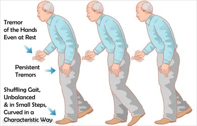 parkinson's disease