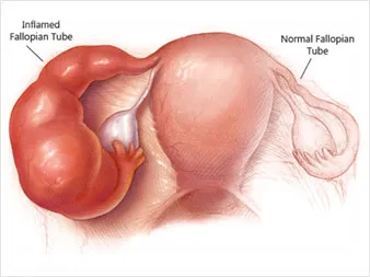 genital chlamydial infection