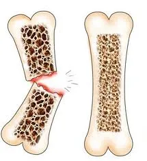 sargassaceae bone