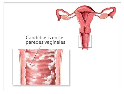 candida vaginitis