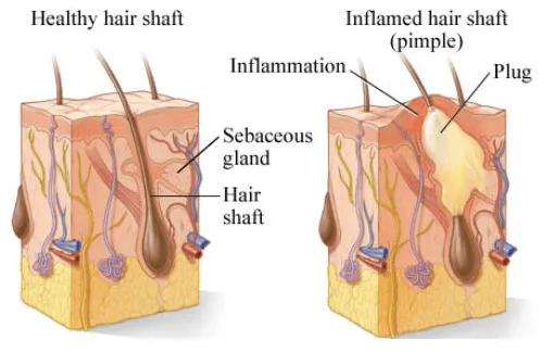 excoriated acne