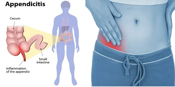 acute appendicitis