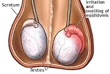 mumps testis