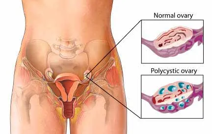 mumps ovarian