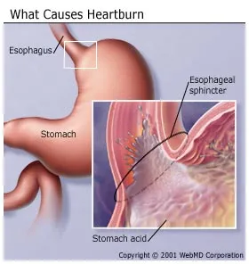 reflux esophagitis