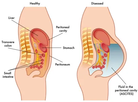 ascites-healthy