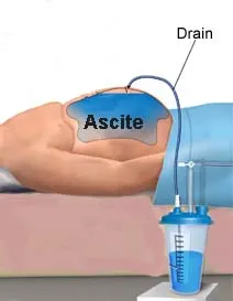 ascites mechanism