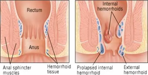 hemorrhoids