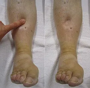 Swelling legs