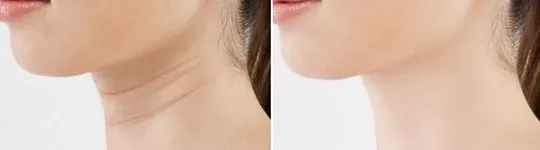 neck-skin-before-after