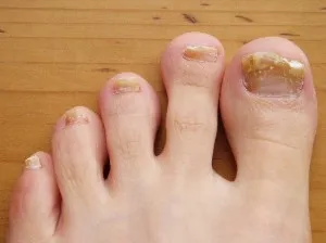 tea-tree-toenail