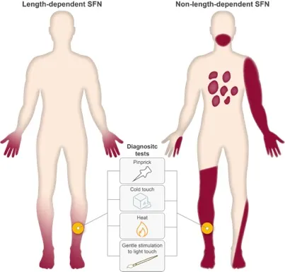 Neuropathy roots