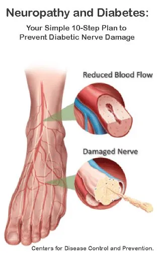 Neuropathy foot