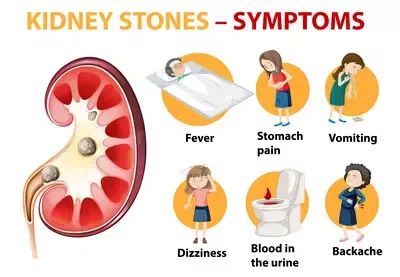 kidney stones