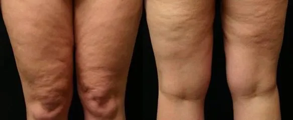 leg-diet-cellulite_2.webp