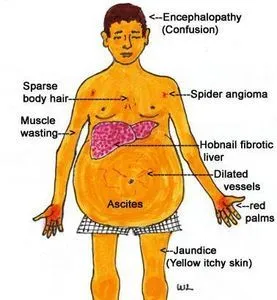 liver-cirrhosis_2.webp