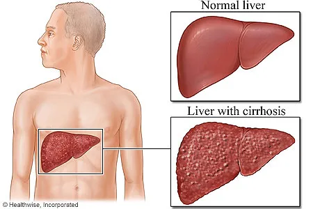 liver-cirrhosis_5.webp