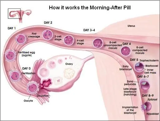 morning-after-pill_5.webp