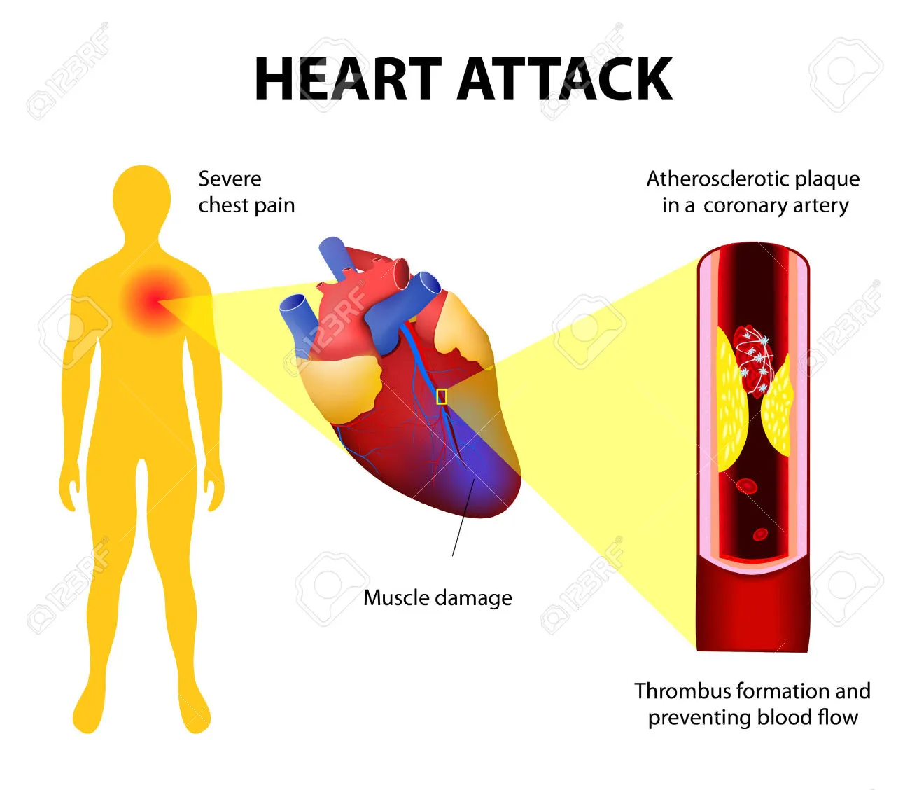 myocardial-infarction_2.webp