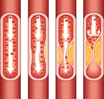 myocardial-infarction_3.webp