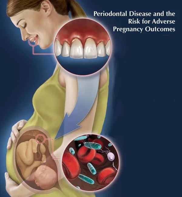 pregnancy-periodontal-disease_2.webp