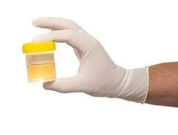 proteinuria_2.webp