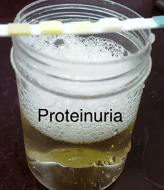 proteinuria_3.webp