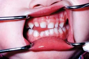 stomatitis-teeth.webp