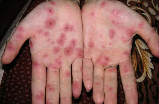 venereal-disease-hands.webp